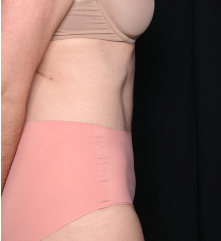 Tummy Tuck Before & After Patient #34348